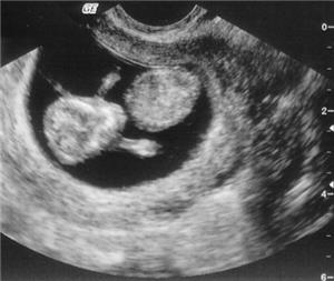 Image: We're having a baby!!!